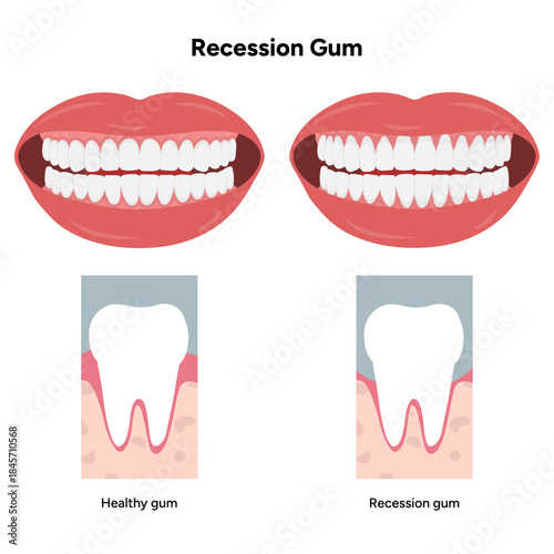 Hand-drawn dental illustration comparing gum recession and healthy gums with detailed anatomy. Educational infographic differences in tooth and gum structure