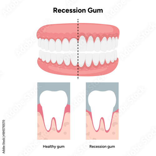 Hand-drawn dental illustration comparing gum recession and healthy gums with detailed anatomy. Educational infographic differences in tooth and gum structure