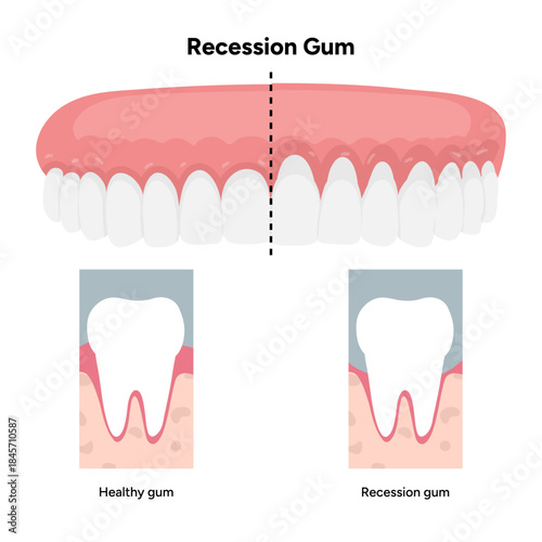 Hand-drawn dental illustration comparing gum recession and healthy gums with detailed anatomy. Educational infographic differences in tooth and gum structure