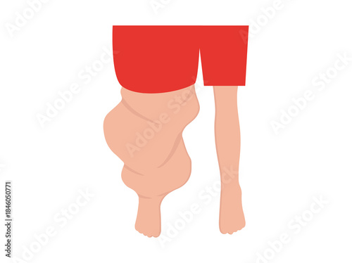 Elephantiasis Disease from Filaria Worm Parasite
