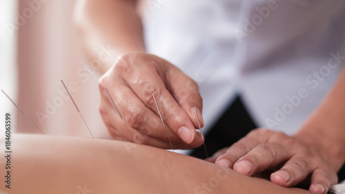 Close-up shot of Oriental healing, Asian physiotherapist treats patient's back muscle pain relief by acupuncture hand procedure, passive medical therapy at healthcare wellness spa in hospital clinic.