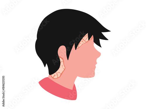 Psoriasis on the Scalp Illustration
