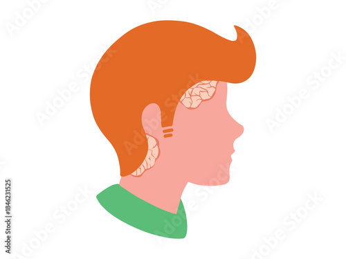 Psoriasis in Scalp Skin Illustration