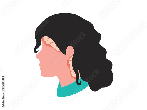 Psoriasis in Scalp Skin Illustration