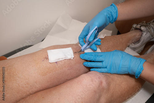 Slika na platnu Surgical staples being removed by nurse from woman's knee after knee replacement operation
