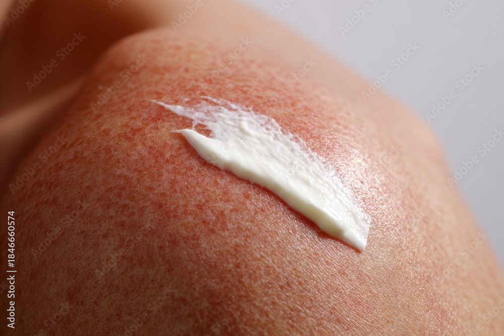 Fototapeta premium Close-up of Soothing Sunblock Application on Reddened Shoulder with Thick White Cream Texture for Sun Protection Concept