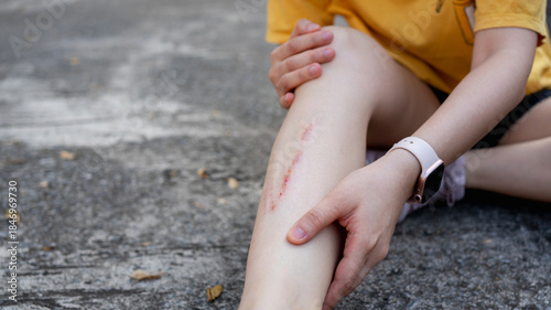 Photography Minor leg injury with scrape after falling on pavement