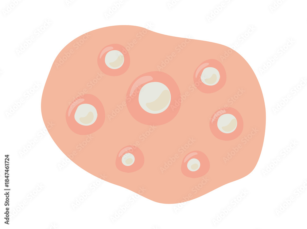 Fototapeta premium Acne Whitehead in Skin