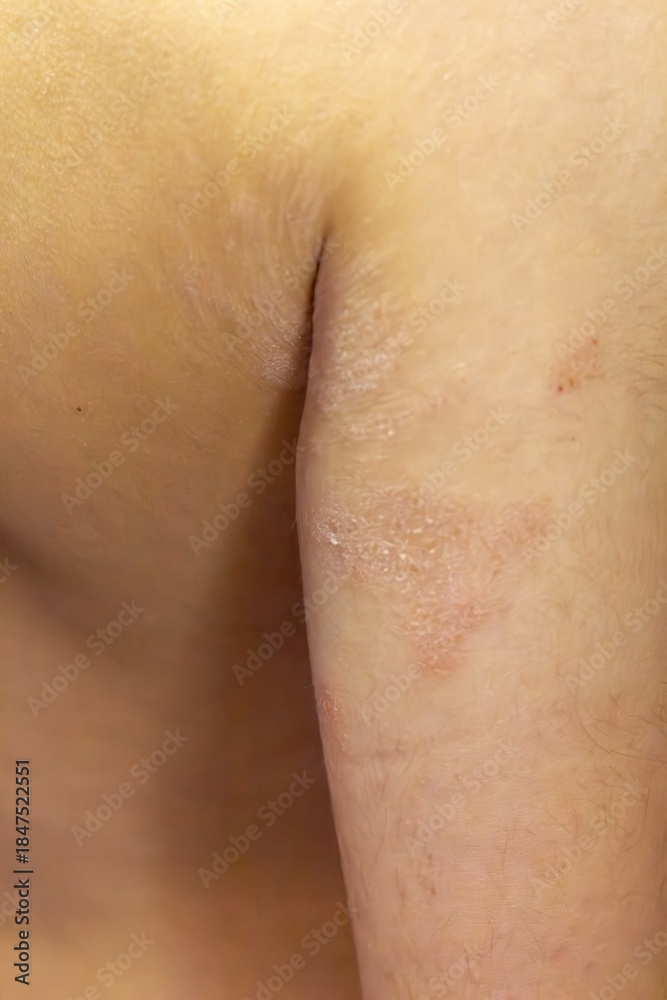 Fototapeta premium Atopic dermatitis skin inflammation on arm close up detailed view