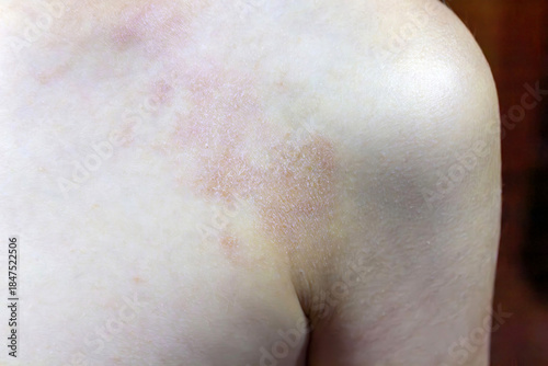 Tableau sur toile Atopic dermatitis skin rash on child's arm close up view
