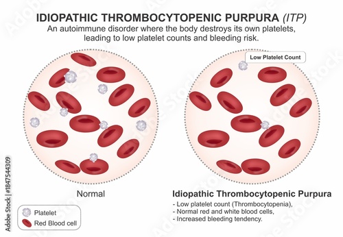 Idiopathic Thrombocytopenic Purpura (ITP) Medical Infographic Flashcard