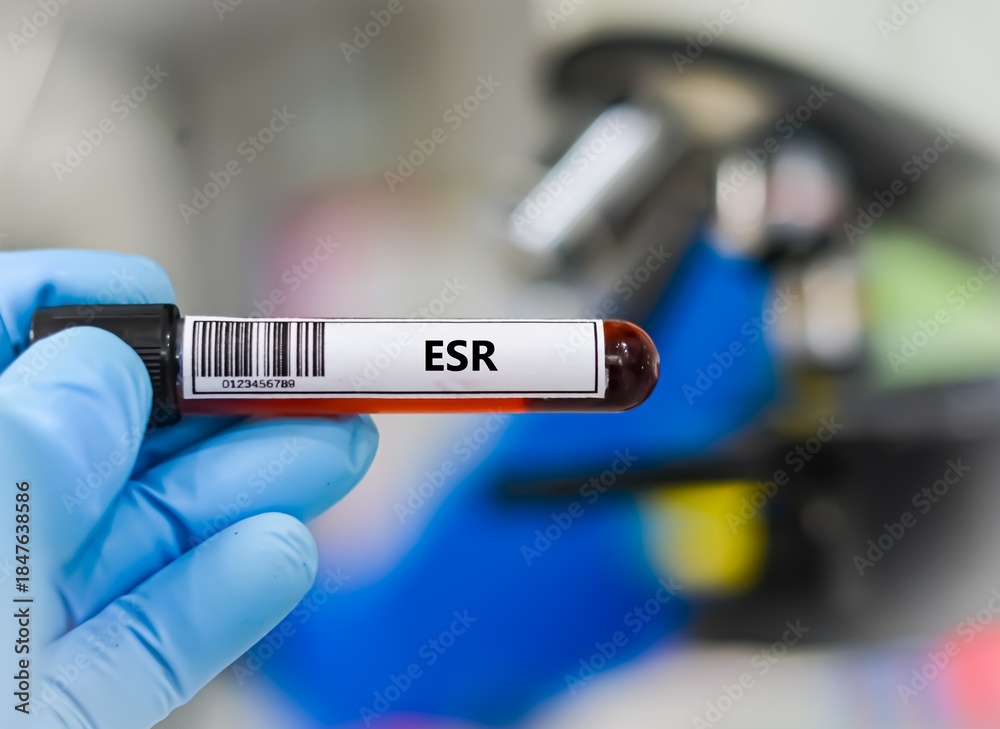 Obraz premium Blood sample tube for ESR test analysis.