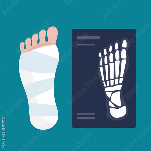 Leg injury treatment. Injured human foot with bandage, medical aid, x-ray. Medicine, health care, accident or trauma