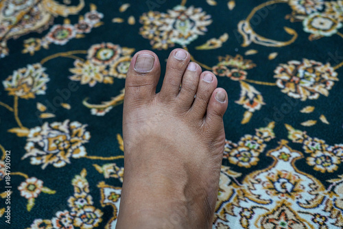 Close-up, overhead shot of a bare human foot resting on a dark patterned rug or carpet. Feet that are striped from sunburn.
