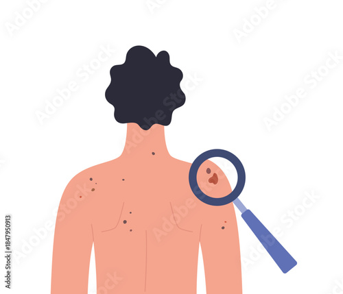 Dermatology screening. Dermatoscopy examination. Skin cancer diagnosis of a man. Healthcare vector illustration