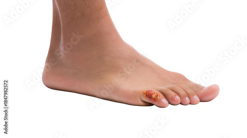 Redness and inflammation are visible on the sole and toes of a person suffering from diabetic foot ulcer, a serious complication of diabetes, isolated on a transparent background
