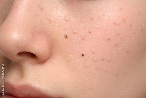 Photorealistic 3D depiction of comedonal acne (blackheads and whiteheads), close-up of cheek and nose-area skin only, multiple small closed comedones and a few open comedones