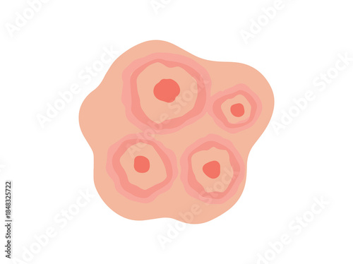 Acne Nodule in Skin Clip Art
