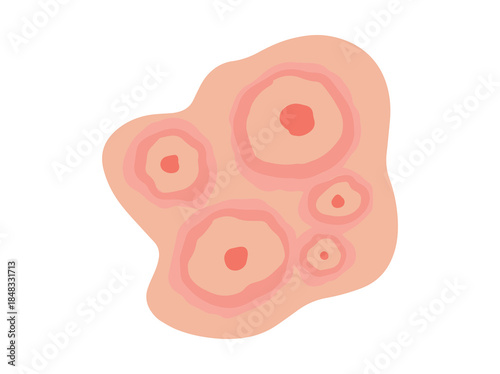 Erythema Migrans in Skin Illustration