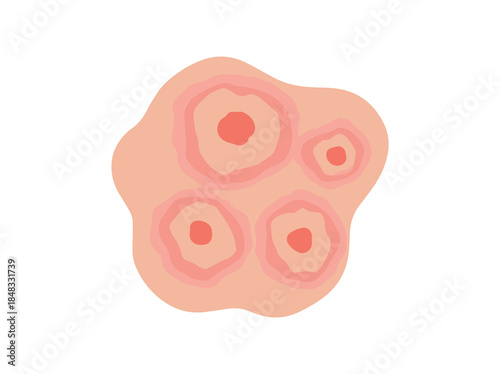 Erythema Migrans in Skin Illustration
