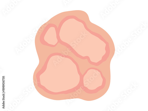 Erythema Marginatum Redness Clip Art
