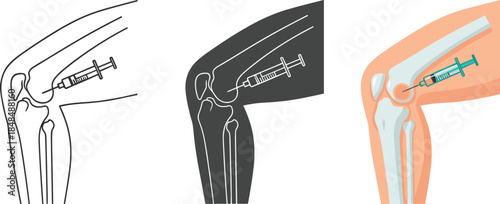 Knee injection isolated on white background medical procedure to treat joint pain and inflammation hyaluronic acid injection for osteoarthritis vector illustration