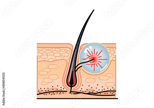 Diagram illustrating hair follicle inflammation and infection causing a painful pimple or boil in the skin layer