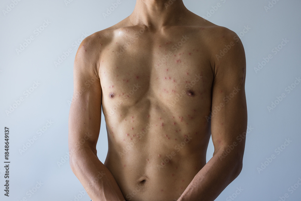 Fototapeta premium Male torso with allergy rash health concept