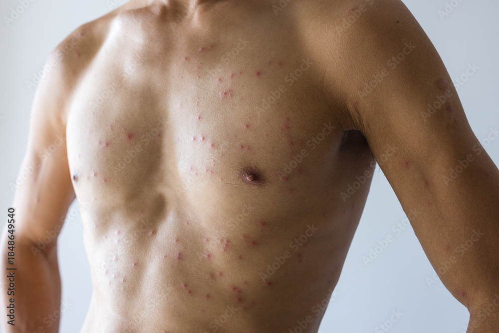 Fototapeta premium Male upper body showing medical skin condition
