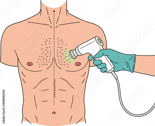 Vector Illustration of Male Torso Receiving Laser Hair Removal Treatment on Chest, Symbolizing Grooming, Dermatology, and Aesthetic Procedures