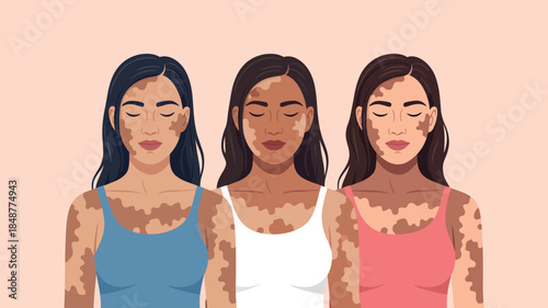 Vitiligo Awareness Women with Skin Conditions