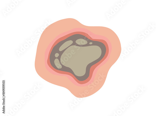 Hand Drawn Necrosis Dead Tissue
