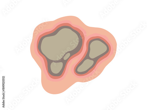 Necrosis Dead Tissue in Skin