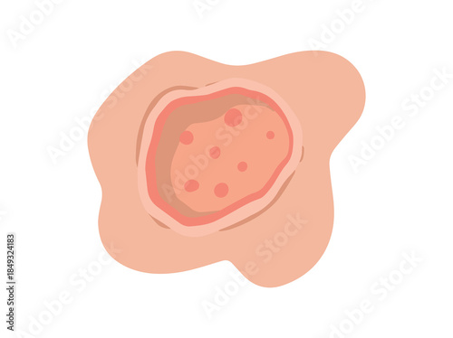 Ulcer Open Sore in Skin
