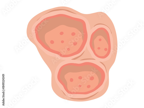 Hand Drawn Ulcer Open Sore
