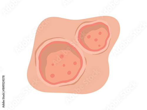 Hand Drawn Ulcer Open Sore
