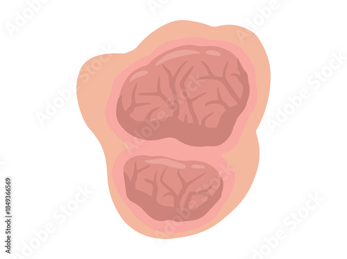 Hand Drawn Tumor Solid Mass
