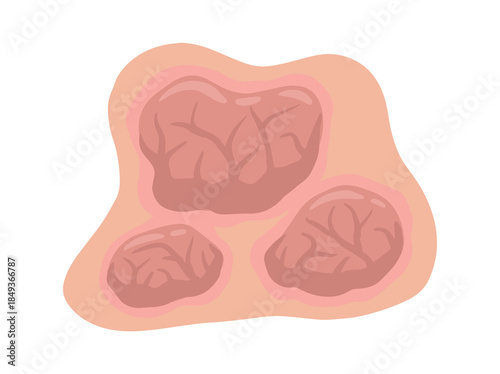 Tumor Solid Mass Clip Art
