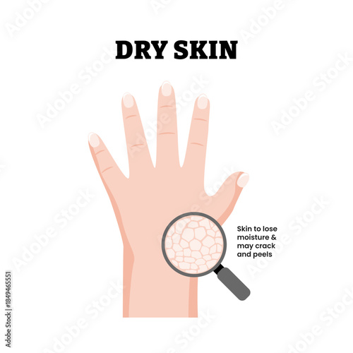 Dry Skin Hand Condition Symptoms Medical Illustration. Showing cracked and dehydrated skin texture. Skin to lose moisture. Dermatology. Skin barrier disorder. Flat vector illustration