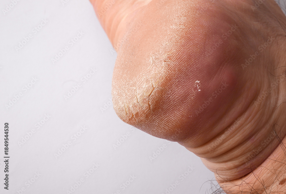 Fototapeta premium Cracked skin on the heel close up. Man's leg