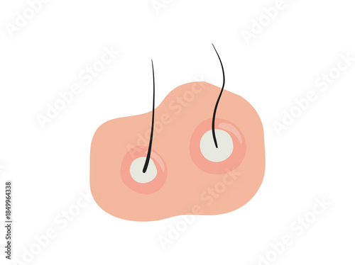 Folliculitis in Scalp Clip Art