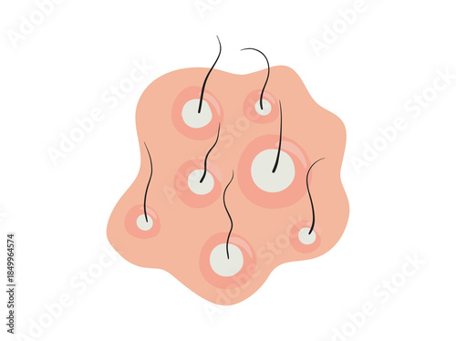 Folliculitis in Scalp Clip Art