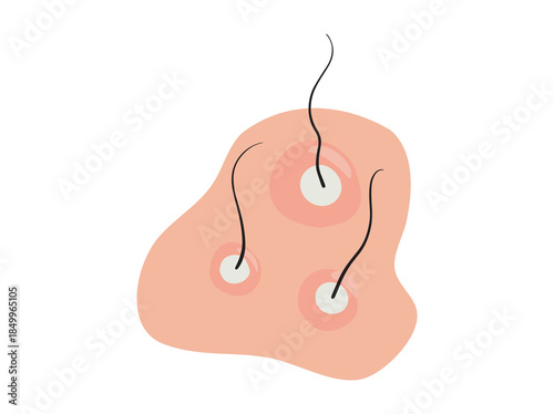 Hand Drawn Folliculitis in Scalp