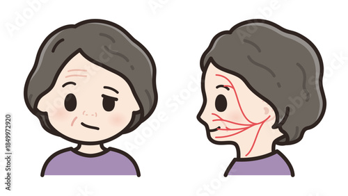 左顔面神経麻痺の顔と顔面神経の運動神経の走行のイラスト