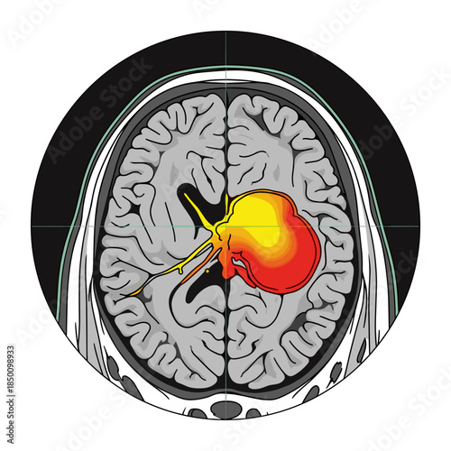 Brain tumor scan in medical imaging style with vibrant colors