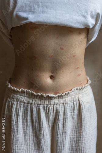 Pityriasis rosea (Gibert's disease) on a girl's stomach. Pityriasis rosea, a rash on the body.
