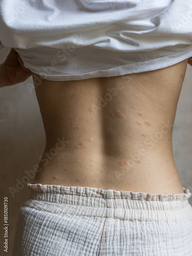 Pityriasis Rosea on the back. Skin rashes, infectious diseases.