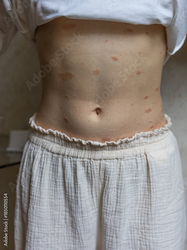 Pityriasis rosea (Gibert's disease) on a girl's stomach. Pityriasis rosea, a rash on the body.