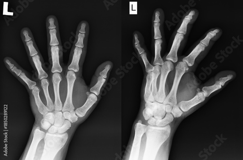 Actual X-rays of the man's left hand. Two views of the healthy hand.