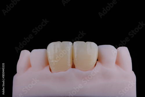 High-quality naturally dental single crowns made of zirconium for fixation to the frontal teeth of upper jaw.